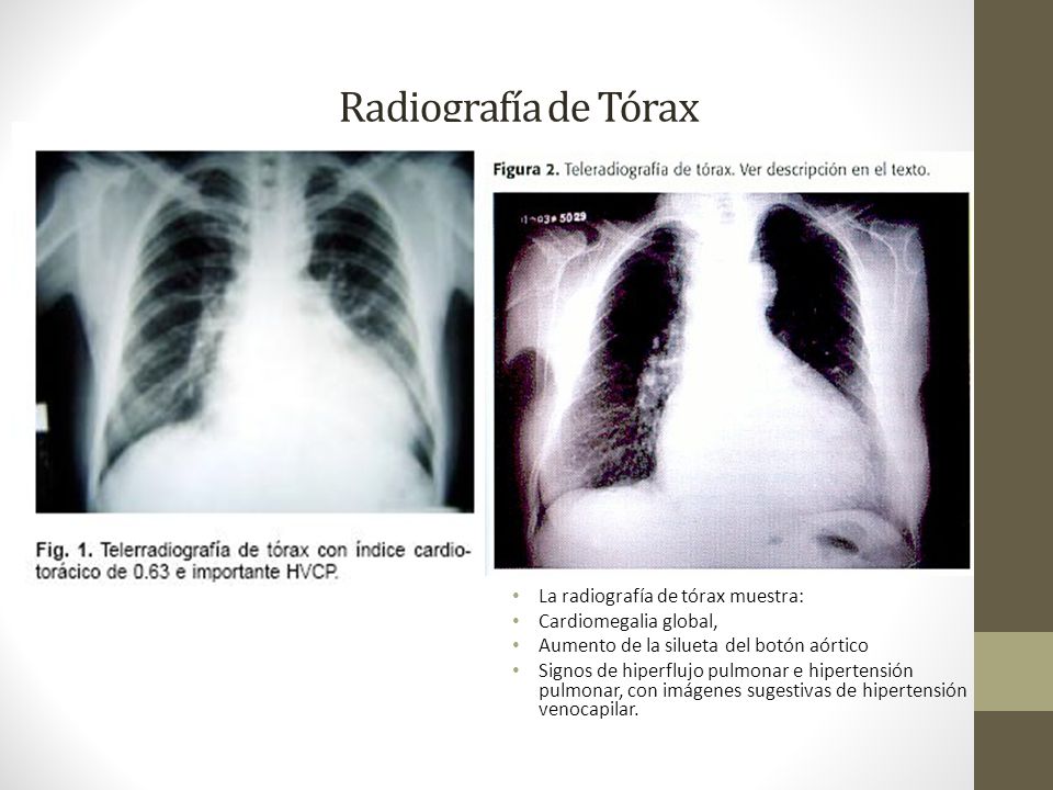 Hipertensión pulmonar en tomografía computarizada